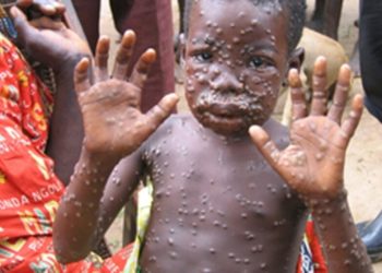 Mpox en RDC : la zone de santé de Beni s&rsquo;active dans la lutte