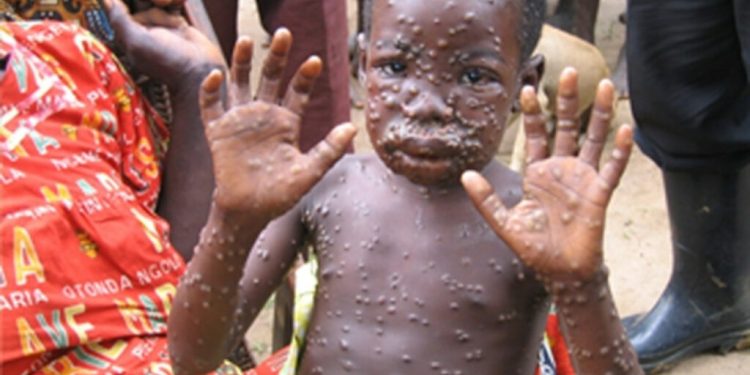 Mpox en RDC : la zone de santé de Beni s&rsquo;active dans la lutte
