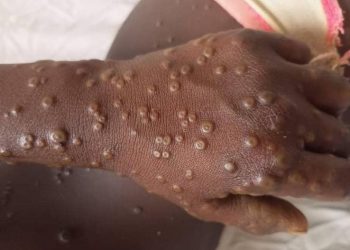 Mpox au Nord-Kivu : « Le nombre de cas augmente quotidiennement », (DPS)