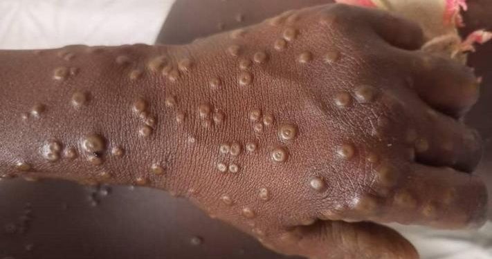Mpox au Nord-Kivu : « Le nombre de cas augmente quotidiennement », (DPS)