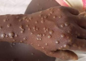 Mpox : la RDC connaît une baisse du taux de létalité à 1,6 %