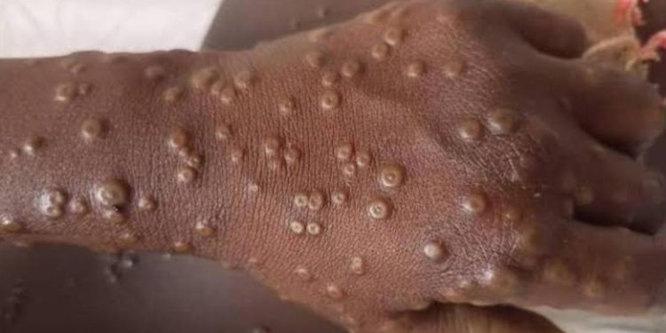 Mpox : la RDC connaît une baisse du taux de létalité à 1,6 %