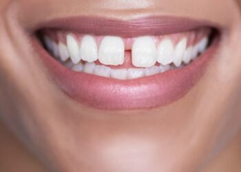Butembo : un dentiste prévient sur les risques associés à la technique d&rsquo;obtention de diastème