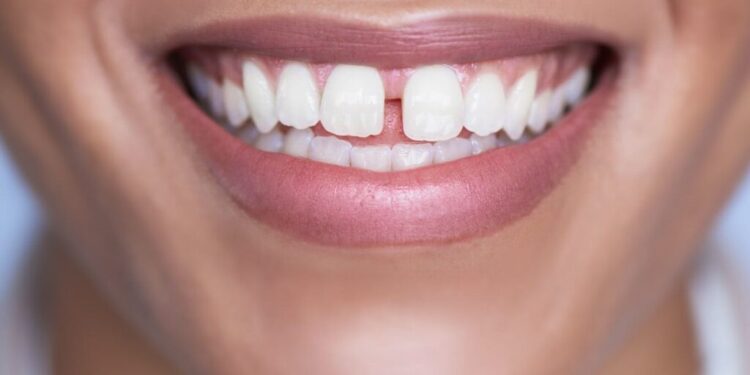 Butembo : un dentiste prévient sur les risques associés à la technique d&rsquo;obtention de diastème