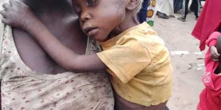 Problème de malnutrition à Lubero : indignée, la Fondation Bakalania crie au secours