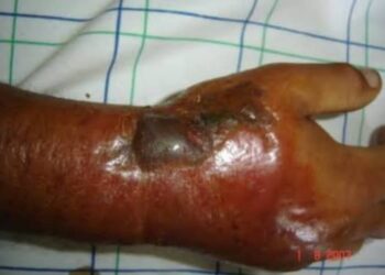 Nord-Kivu : six cas suspects de l’anthrax dont un décès enregistrés dans la zone de santé de Lubero