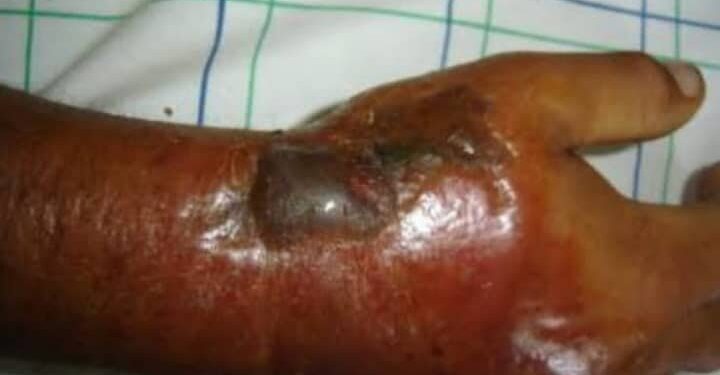 Nord-Kivu : six cas suspects de l’anthrax dont un décès enregistrés dans la zone de santé de Lubero