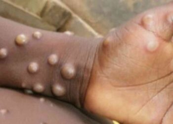 RDC : le Gouvernement déclare la fin de l&rsquo;épidémie de Mpox