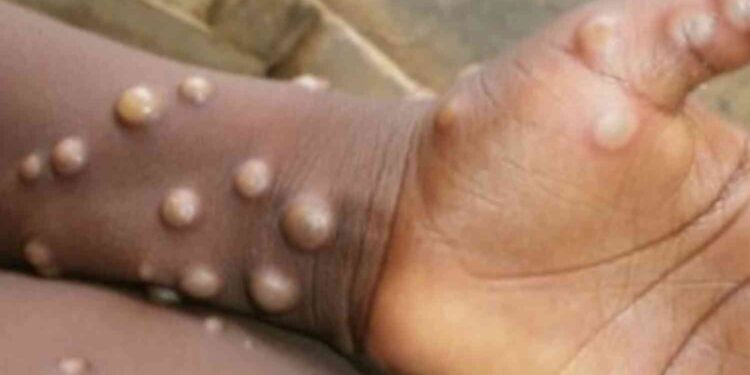 IMG-20260403-WA0103 - Agora Grands-Lacs RDC : le Gouvernement déclare la fin de l’épidémie de Mpox